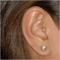 Open-Fit Behind-The-Ear (BTE) hearing aid